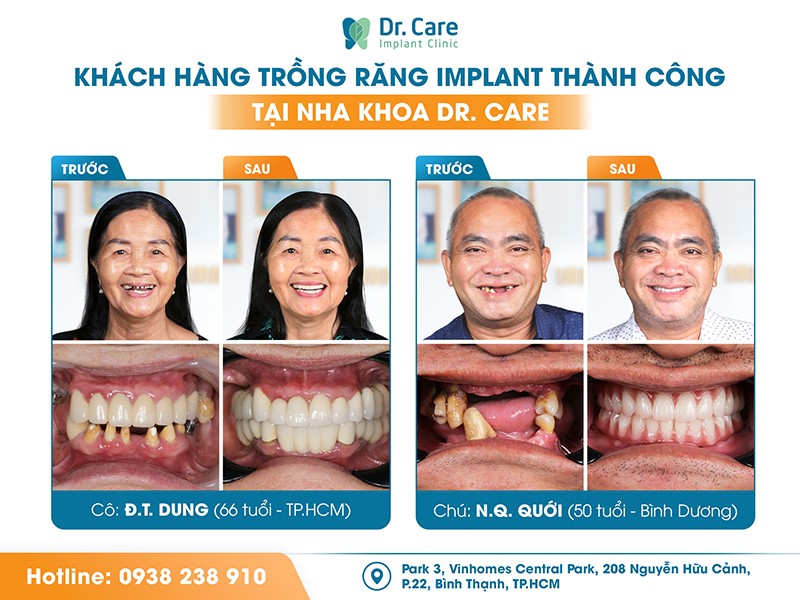 Dr. Care: Nha khoa tiên phong ứng dụng công nghệ cao trong trồng răng Implant - 5