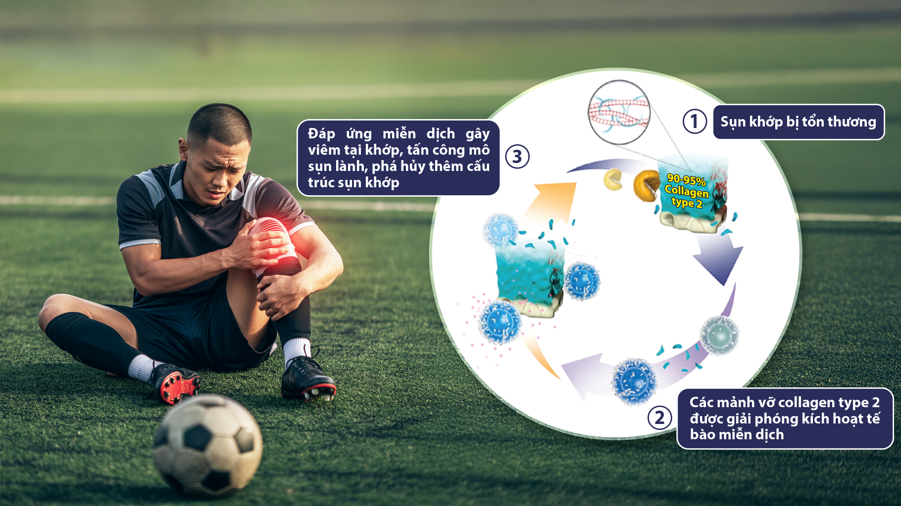 Tổn thương sụn khớp ở người chơi thể thao quá tải: Glucosamine hay Collagen type 2 không biến tính (Collavant n2) phù hợp hơn? - 2