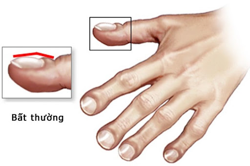 3 dấu hiệu trên ngón tay cảnh báo phổi đang bị “tàn phá”, đi khám ngay kẻo “ân hận cả đời”! - 1