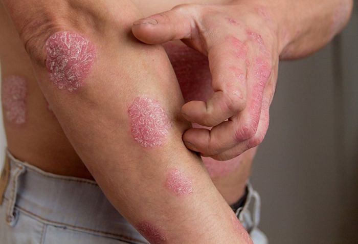 Giải mã bệnh chàm: Nguyên nhân, triệu chứng và phương pháp điều trị hiệu quả - 4