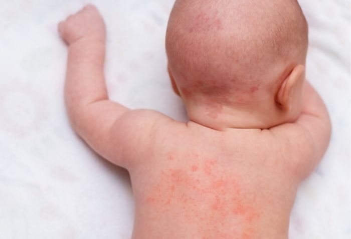 Giải mã bệnh chàm: Nguyên nhân, triệu chứng và phương pháp điều trị hiệu quả - 3