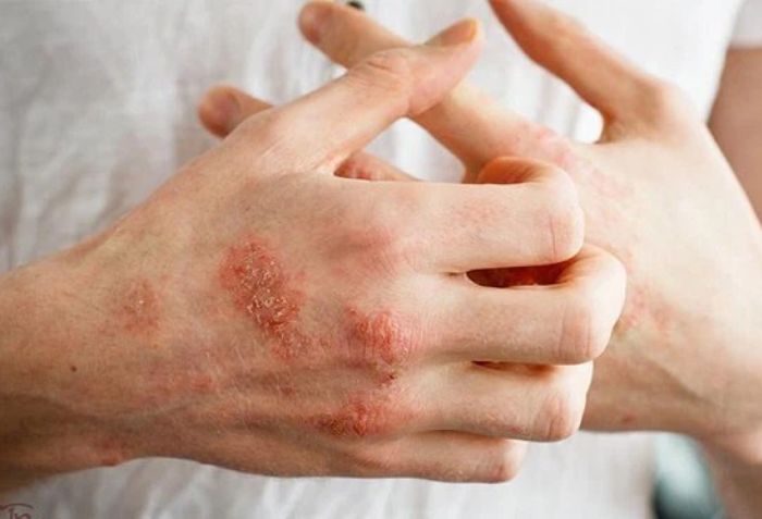 Giải mã bệnh chàm: Nguyên nhân, triệu chứng và phương pháp điều trị hiệu quả - 1