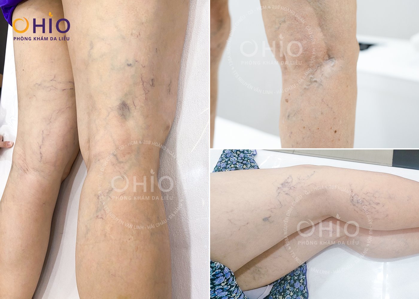 Giãn mao mạch chân đùi: Nguyên nhân và cách điều trị - 1