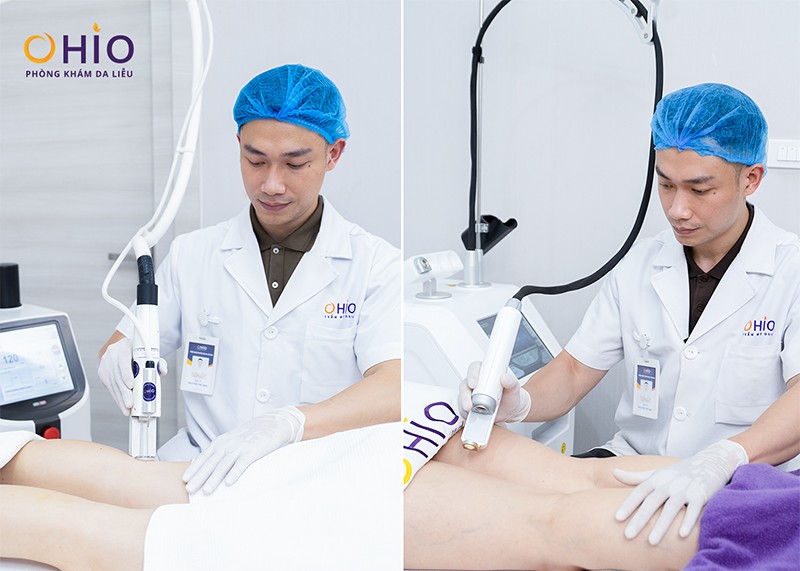 Giãn mao mạch chân đùi: Nguyên nhân và cách điều trị - 3