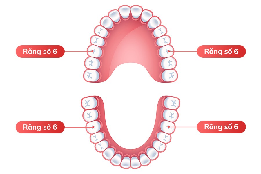 Hậu quả của mất răng số 6 sớm và cách khắc phục hiệu quả - 1