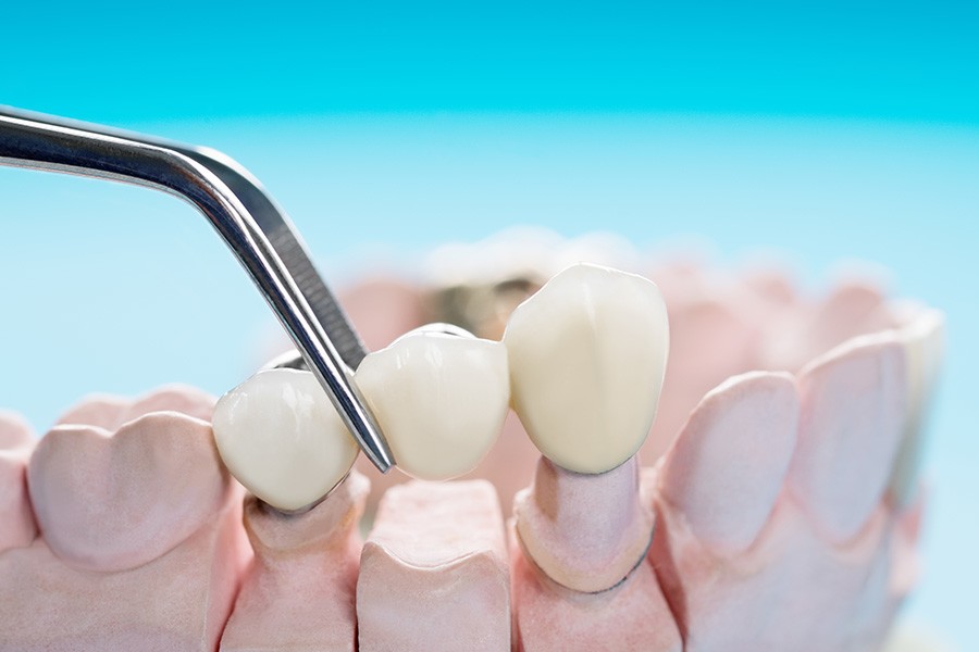 Hậu quả của mất răng số 6 sớm và cách khắc phục hiệu quả - 4