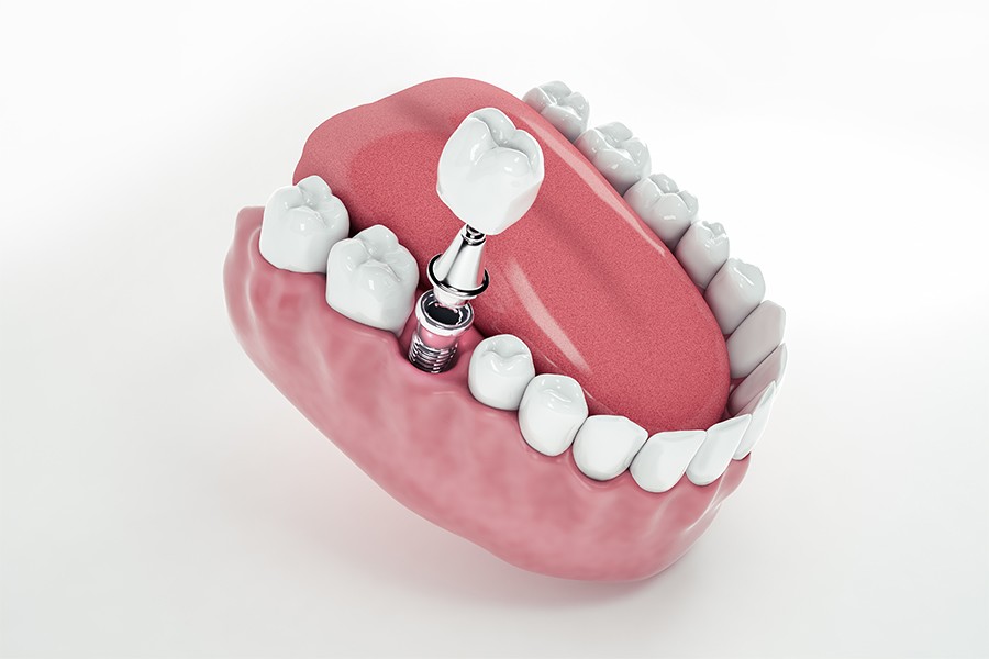 Hậu quả của mất răng số 6 sớm và cách khắc phục hiệu quả - 5