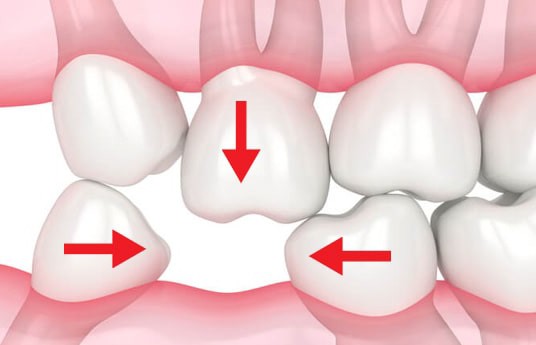Hậu quả của mất răng số 6 sớm và cách khắc phục hiệu quả - 2