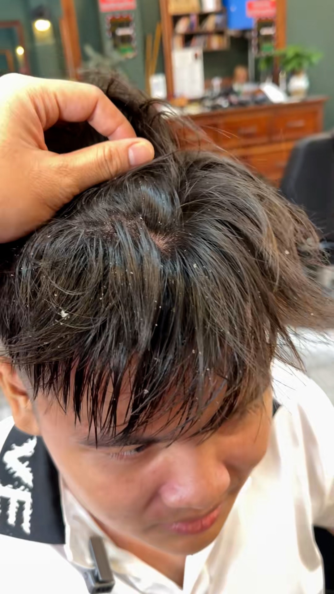 Không chỉ khô da, mùa lạnh đến sớm còn là ‘thủ phạm’ khiến gàu ngứa bùng phát - 1