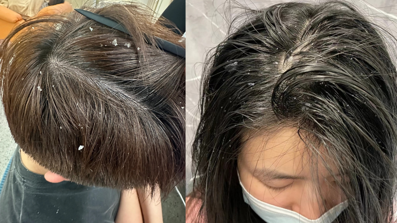 Không chỉ khô da, mùa lạnh đến sớm còn là ‘thủ phạm’ khiến gàu ngứa bùng phát - 4