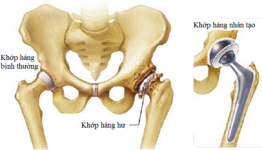 Đau nhức háng tận trong xương cần phải làm ngay điều này! - 2