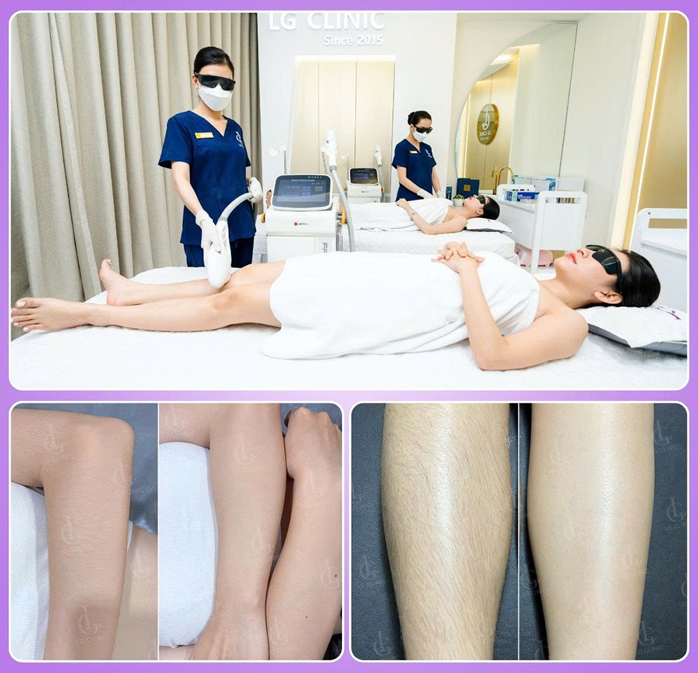 Công nghệ triệt lông LG Cool Hybrid –8°C giúp LG Clinic “vượt mặt” mọi đối thủ nhờ 3 điểm cộng vượt trội này - 3