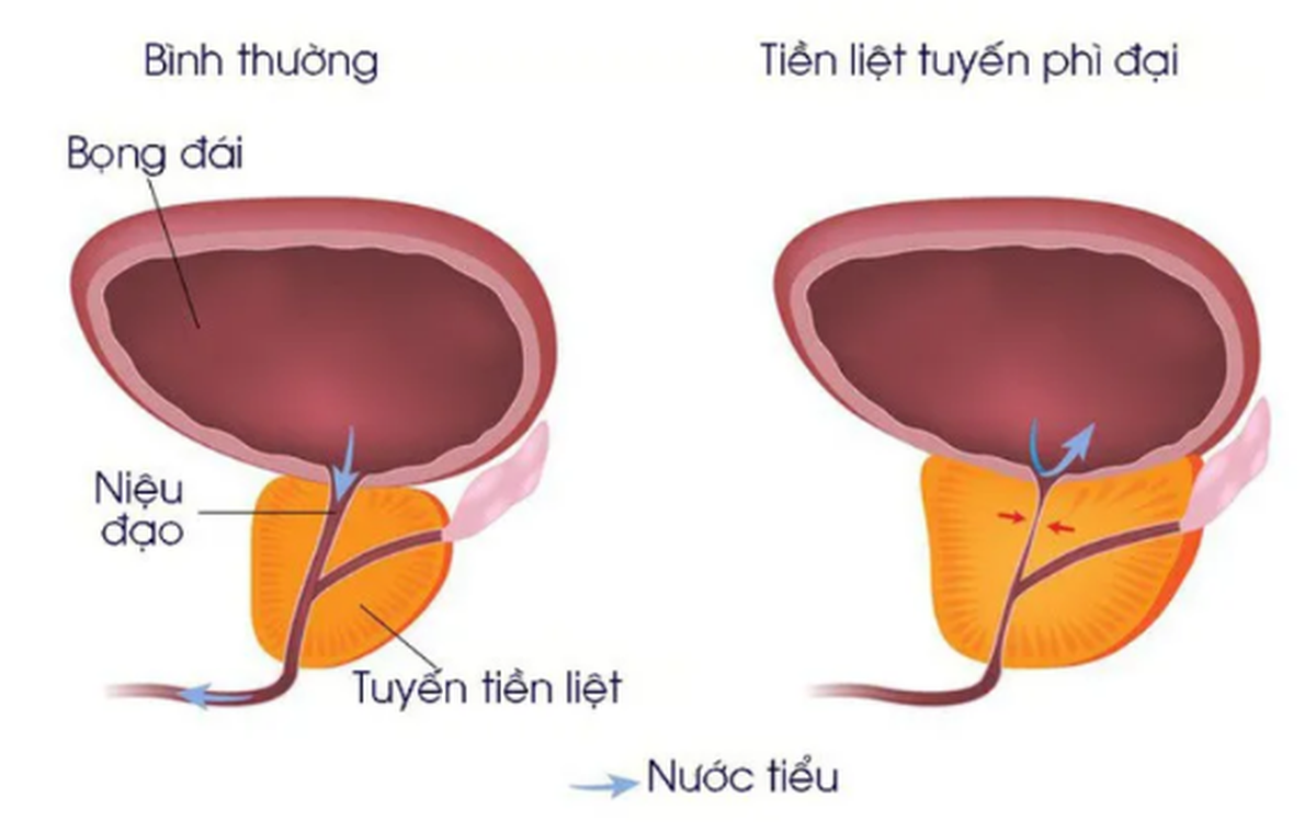 3 dấu hiệu thầm lặng cảnh báo phì đại tuyến tiền liệt mà nhiều quý ông chủ quan - 3