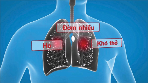 Đàm, ho, khó thở kéo dài mãi chưa dứt? Hãy thử trả lời 5 câu hỏi này trước khi quá muộn! - 2