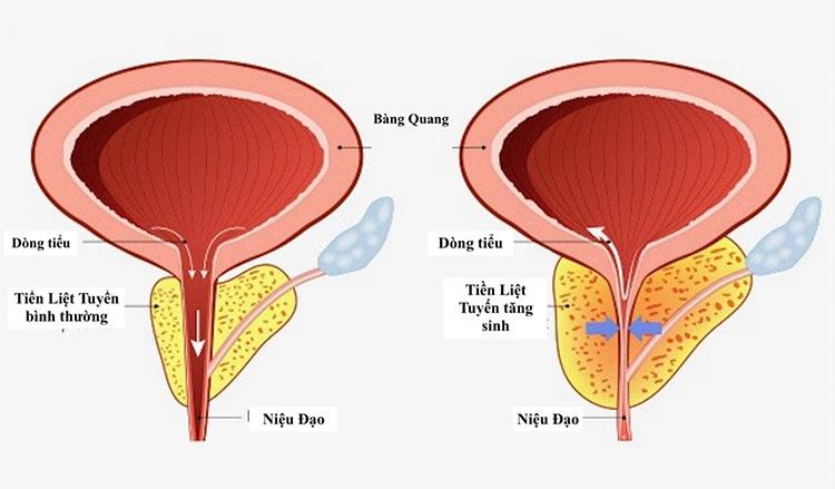 Mách nhỏ quý ông nào bị tiểu đêm nhiều lần, tiểu khó nên làm việc này ngay lập tức - 3