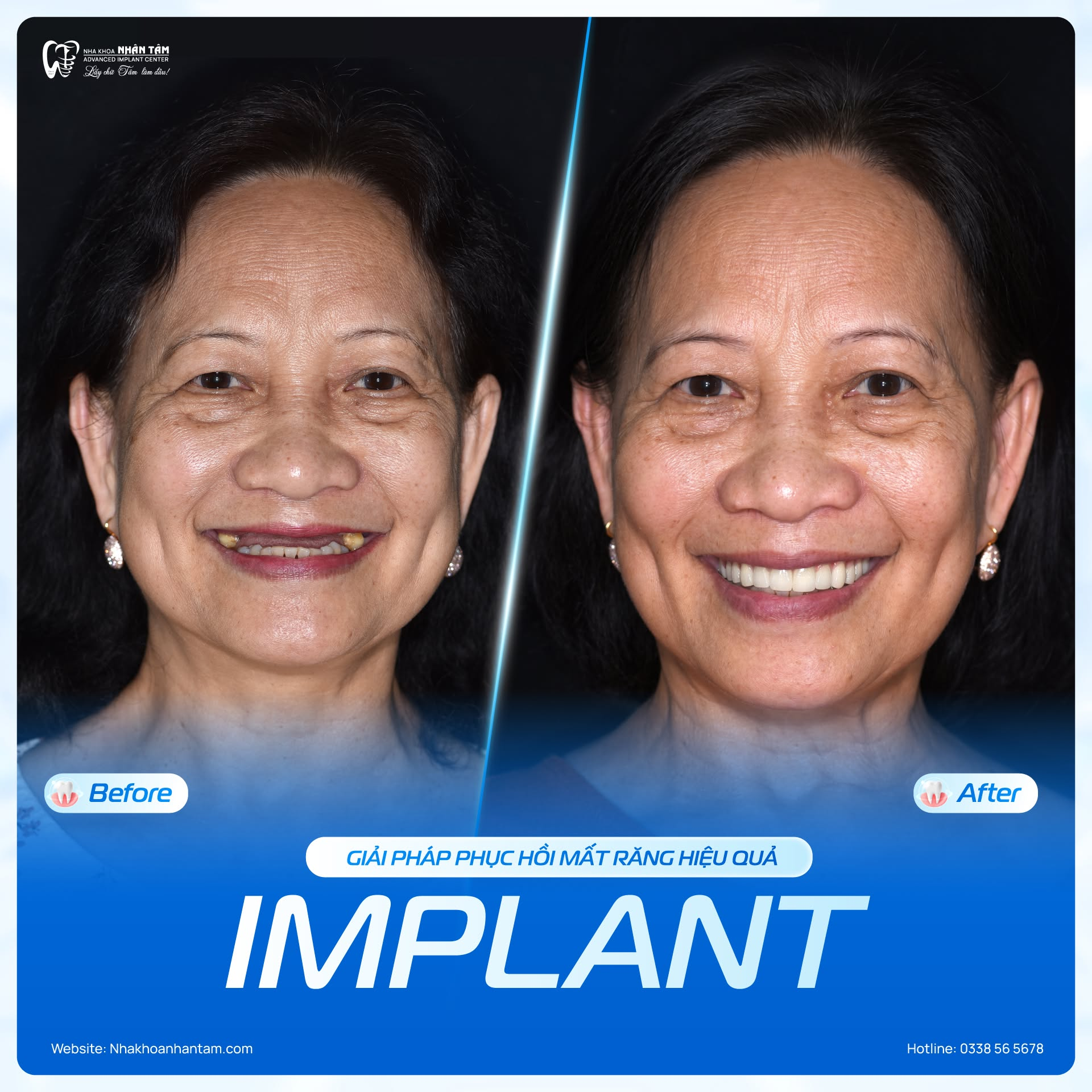 Gần 30 năm hành trình chuyên sâu Implant của Nha khoa Nhân Tâm - 2