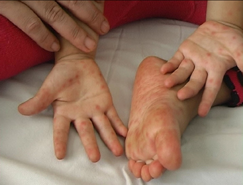 Năm học mới cận kề, cảnh giác nguy cơ gia tăng sốt xuất huyết và các bệnh lây qua đường hô hấp cho trẻ - 2