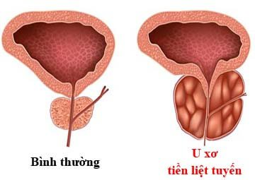 Mới ngoài 40 đã tiểu đêm, tiểu khó: Đừng chủ quan với bệnh phì đại tuyến tiền liệt - 3