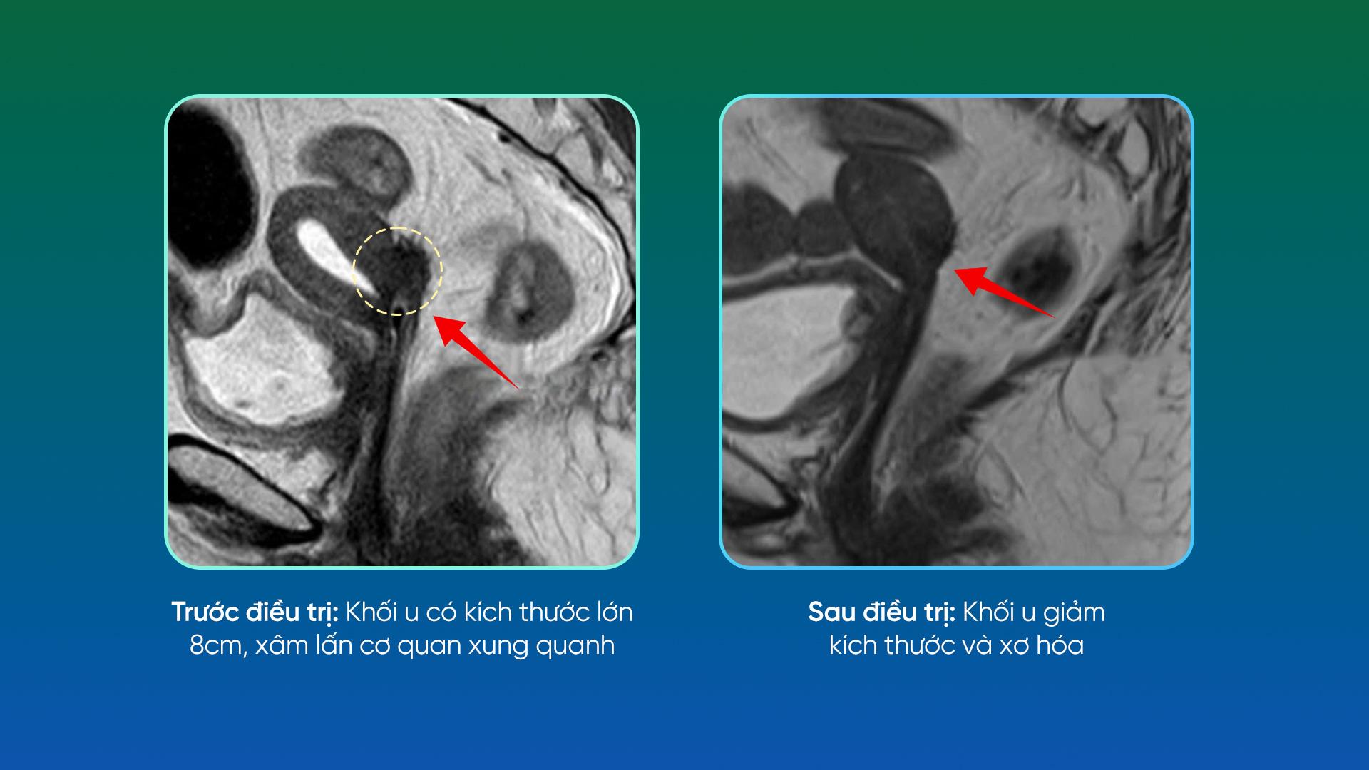 Kỳ tích tại Trung tâm Ung bướu Phương Đông: Khối u giai đoạn muộn 8cm gần như biến mất sau 1,5 tháng - 2