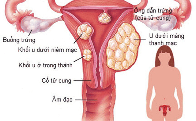 Giải pháp cải thiện u xơ tử cung nhờ sản phẩm thảo dược Nga Phụ Khang - 1