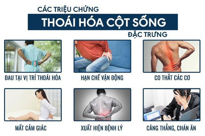 Chuyên gia cảnh báo nguy cơ “thoái hóa sớm” ở người đau lưng, đau vai gáy! - 3