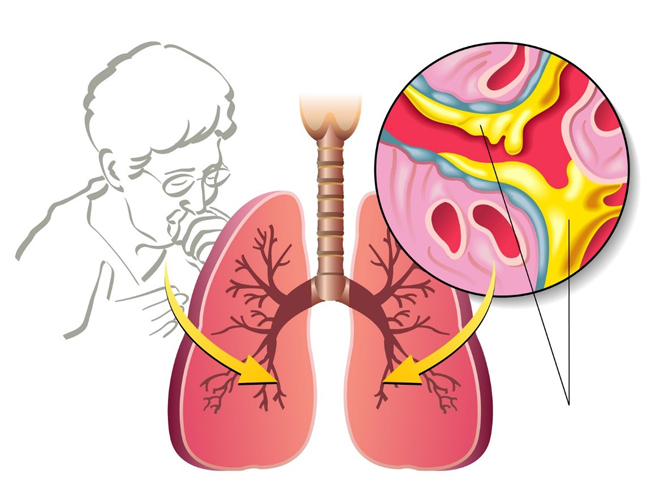 5 màu sắc của đờm “cảnh báo” phổi đang gặp nguy hiểm - 2