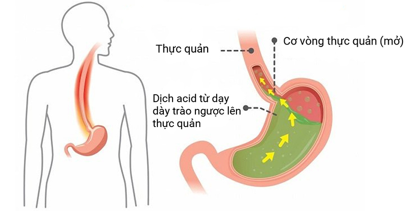 Vì sao bệnh dạ dày hay tái phát vào mùa thu? - 1