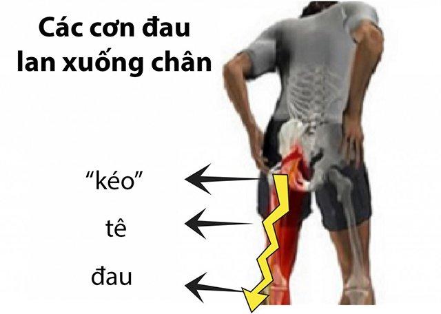 Thoái hóa khớp háng - không điều trị sớm, hối không kịp - 2