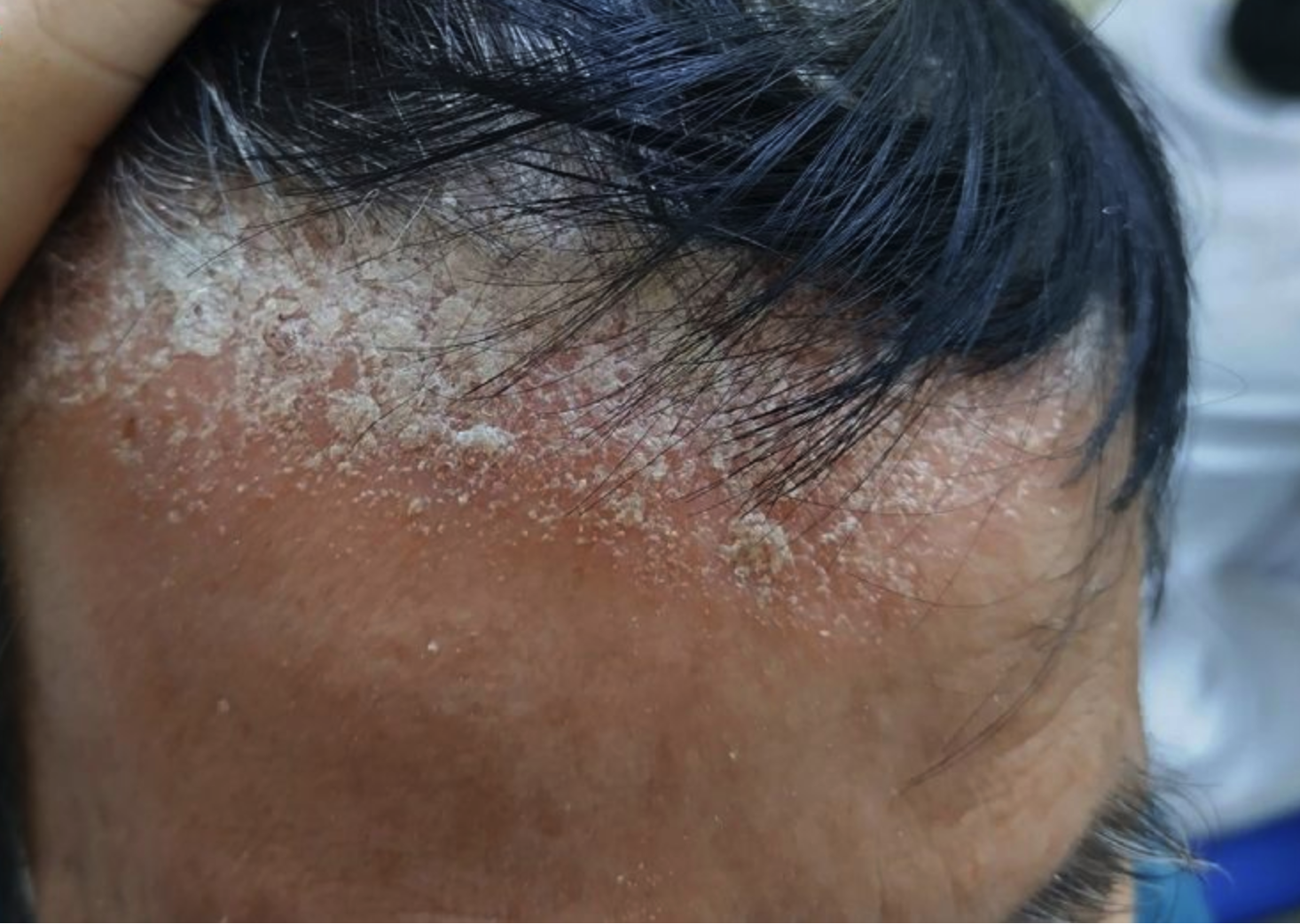 Có thể bạn chưa biết lý do khiến tóc khô xơ, cứng, gàu “trắng đầu” gội mãi không hết! - 2