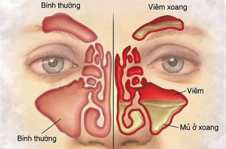 Nghẹt mũi một bên luân phiên kéo dài - Dấu hiệu nhiều bệnh lý mũi xoang nghiêm trọng - 3