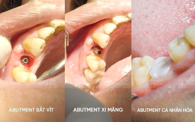Trồng răng implant đơn lẻ sao cho hiệu quả và giải pháp từ chuyên gia - 3