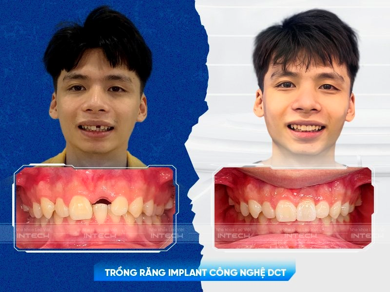 Trồng răng implant đơn lẻ sao cho hiệu quả và giải pháp từ chuyên gia - 4