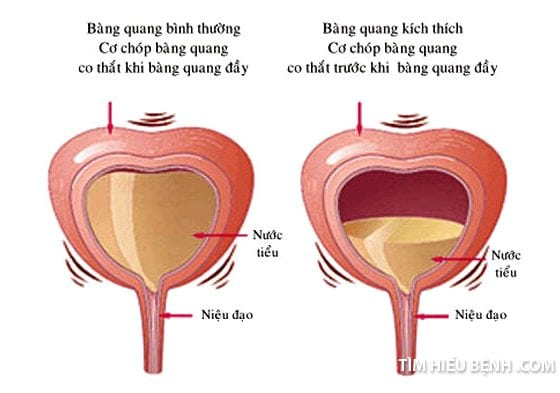 Cứ mưa lạnh là tự nhiên tiểu đêm, tiểu nhiều - Liệu có phải bệnh gì?  - 3