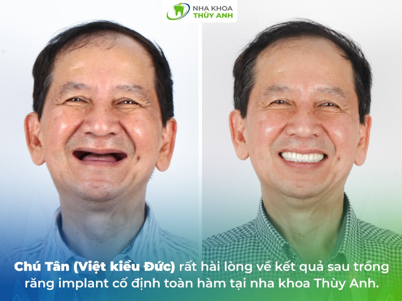 Nha khoa Thùy Anh - Trung tâm trồng răng implant uy tín tại Hà Nội - 5
