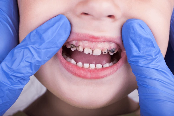 Xịt chống sâu răng Babimoon - Giải pháp mới ứng dụng công nghệ Nhật Bản - 1