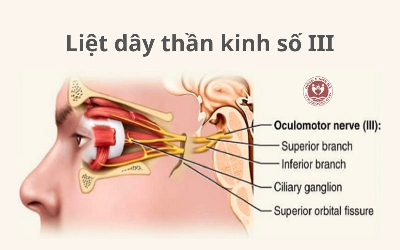 Tại sao liệt dây thần kinh số 3 gây sụp mí mắt? - 2