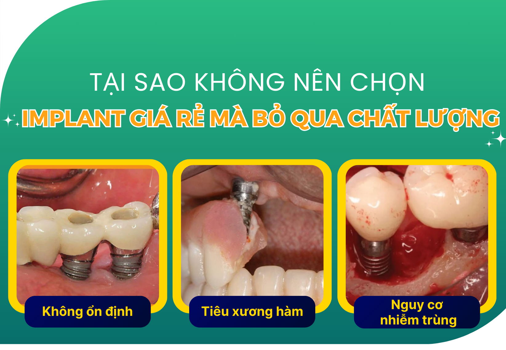 Chọn cấy ghép Implant: Tại sao chất lượng quan trọng? - 2