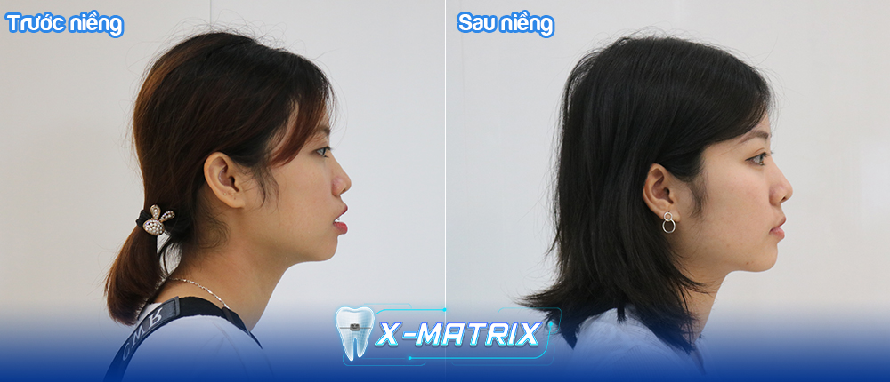 Niềng răng X-Matrix chuẩn tỉ lệ vàng: Giải pháp mới cho vẻ đẹp hoàn hảo! - 3