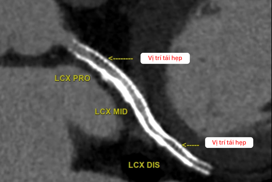 Chụp CT 2560 lát cắt, bệnh nhân thoát khỏi nguy cơ đột tử tim nhờ phát hiện tái hẹp stent kích thước siêu nhỏ - 1