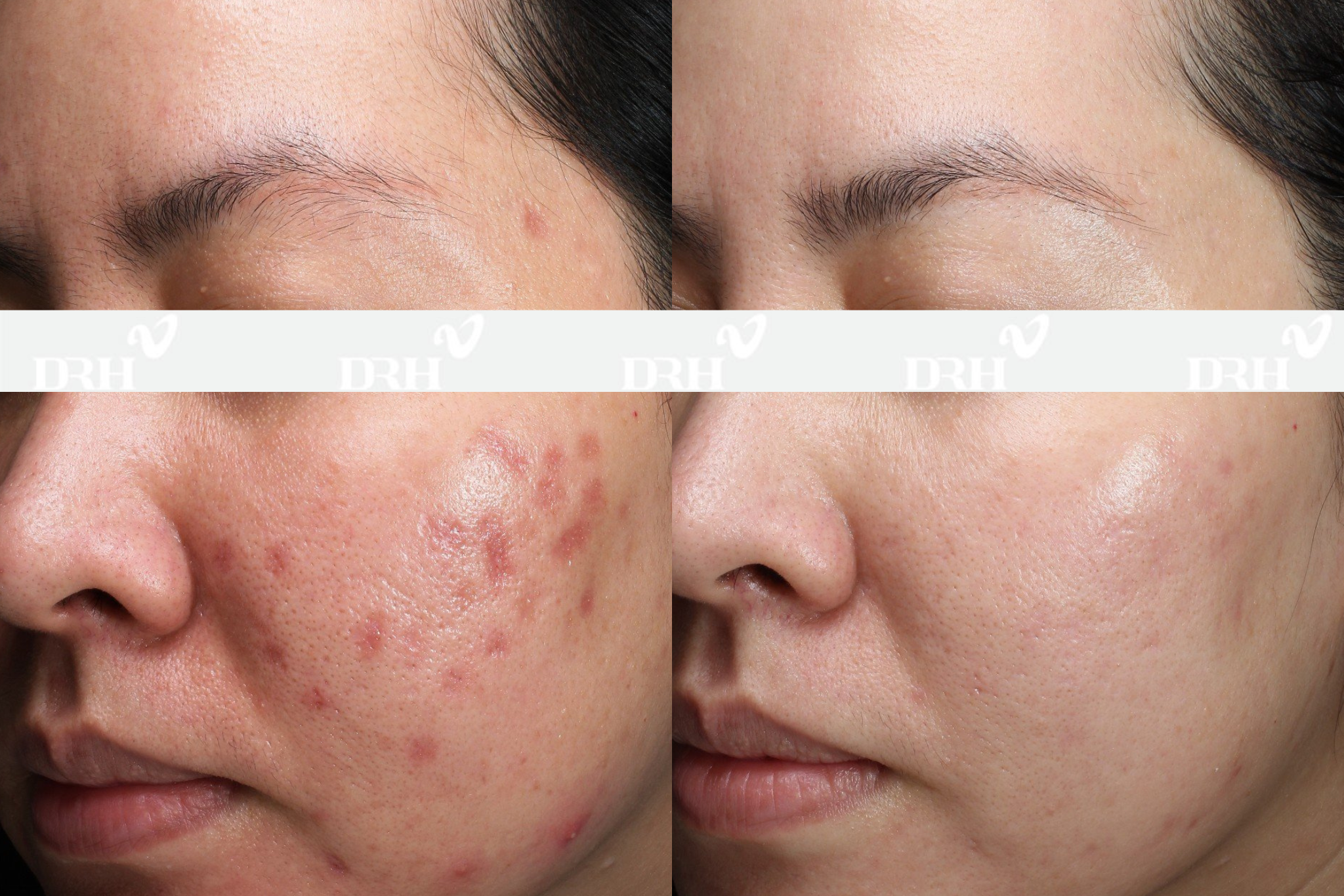 Nói không với làm đẹp cấp tốc, DRH Clinic tài trợ phục hồi da miễn phí - 3