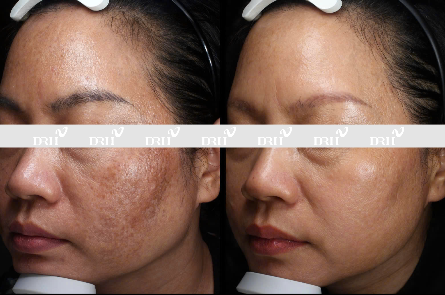 Nói không với làm đẹp cấp tốc, DRH Clinic tài trợ phục hồi da miễn phí - 1