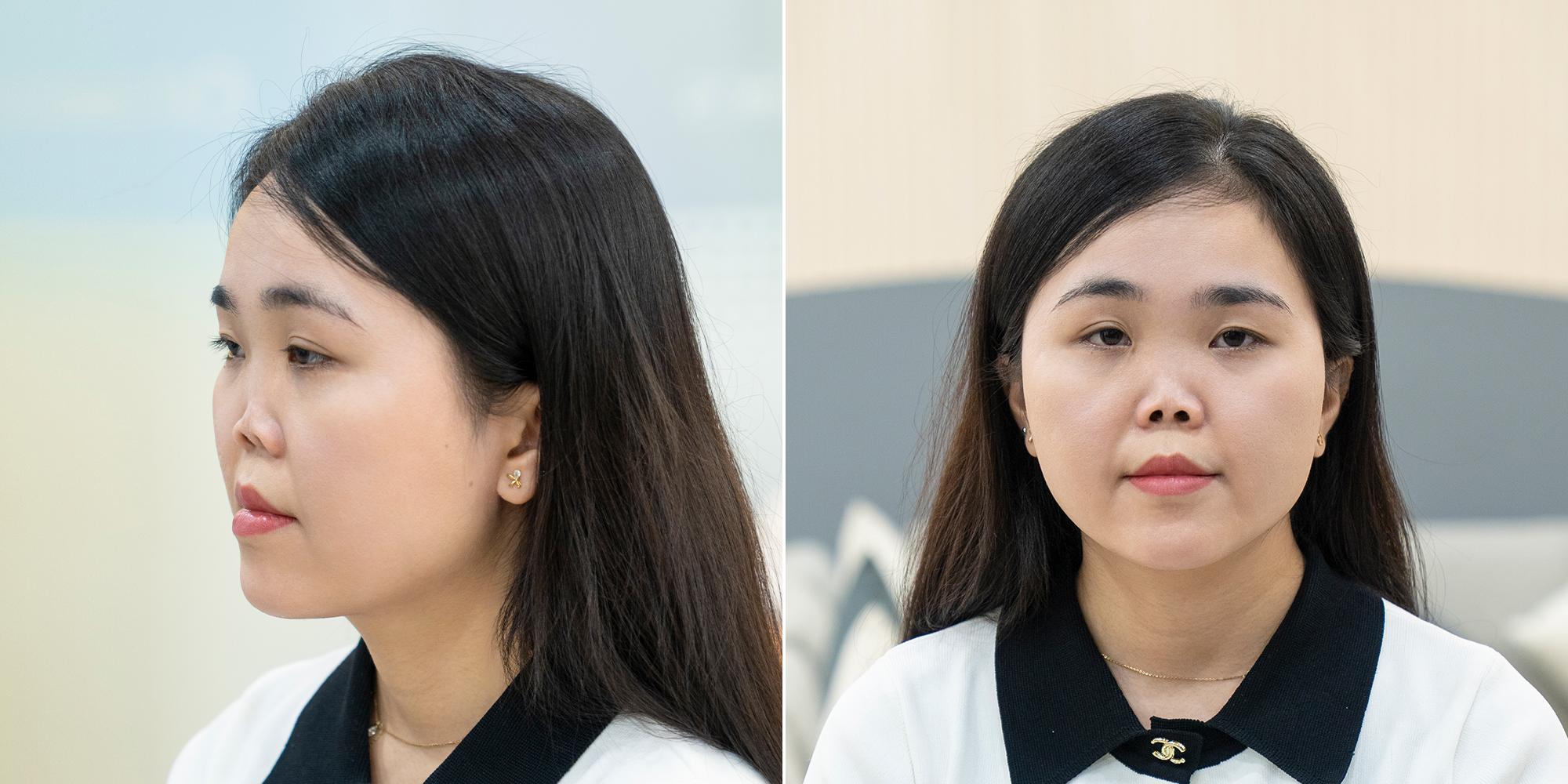 Tái sinh nhan sắc cho cô gái không có sống mũi - 1