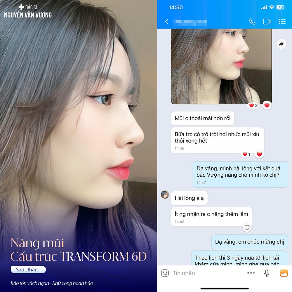 Bác sĩ Vượng và nghệ thuật “Bảo tồn vách ngăn” trong nâng mũi hiện đại - 6
