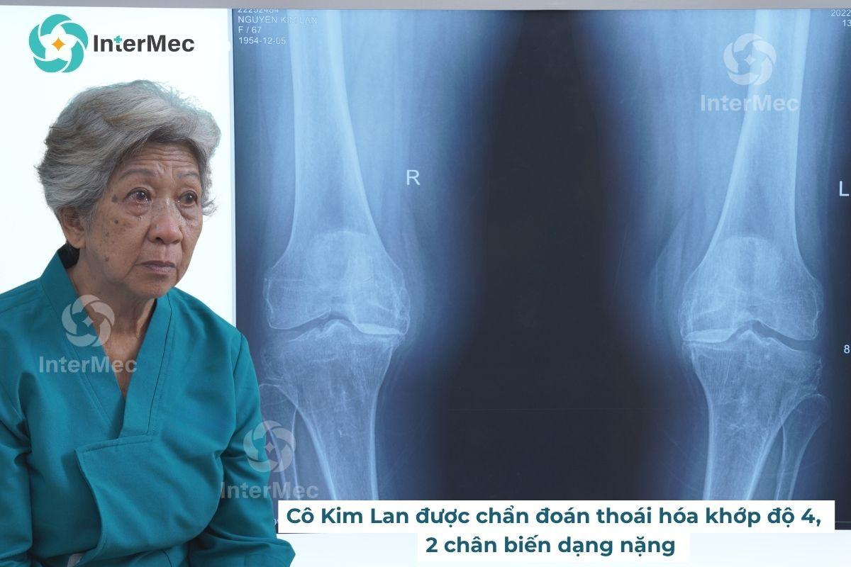 Thoái hóa khớp: Lối thoát nào cho người già sợ phẫu thuật? góc nhìn từ chuyên gia InterMec - 4