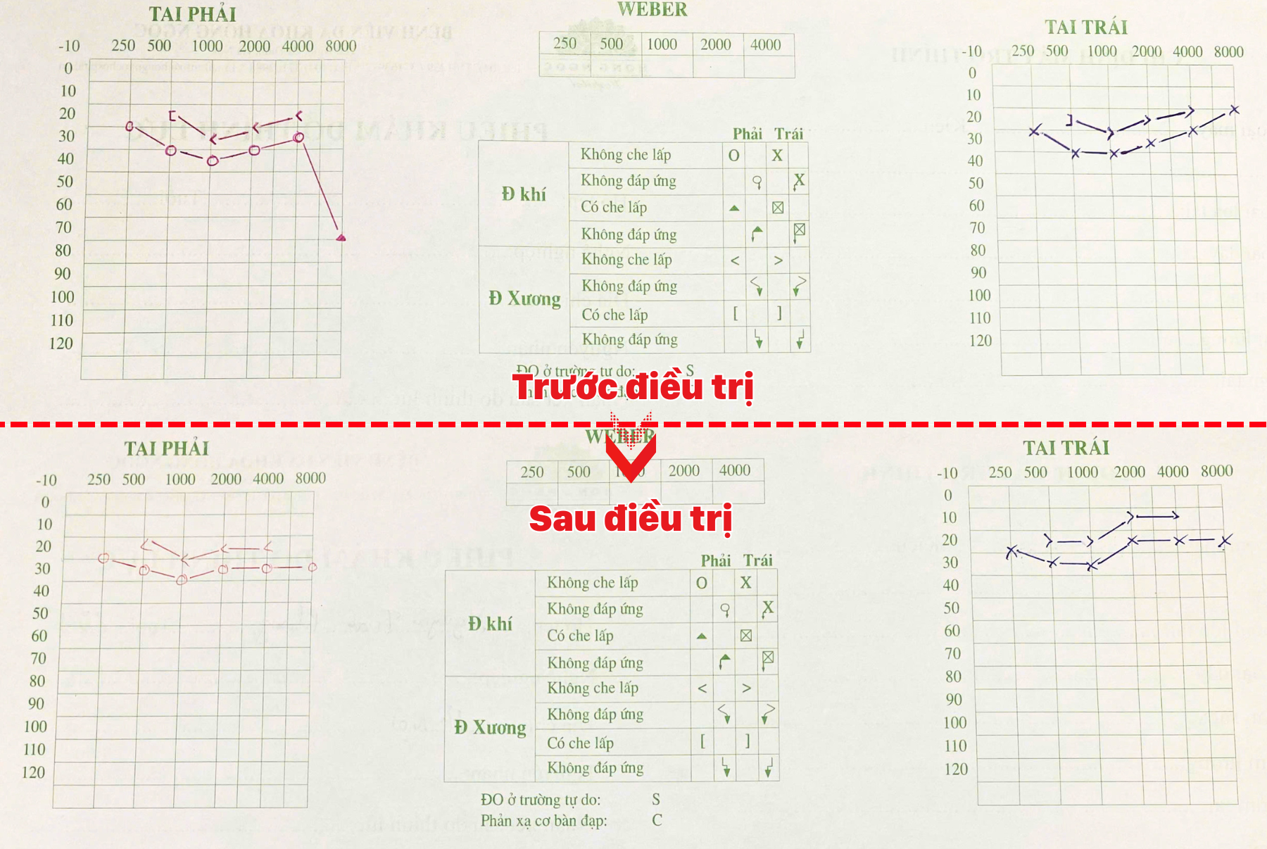 Đeo tai nghe suốt 5 giờ, nam thanh niên đột ngột mất thính lực - 3
