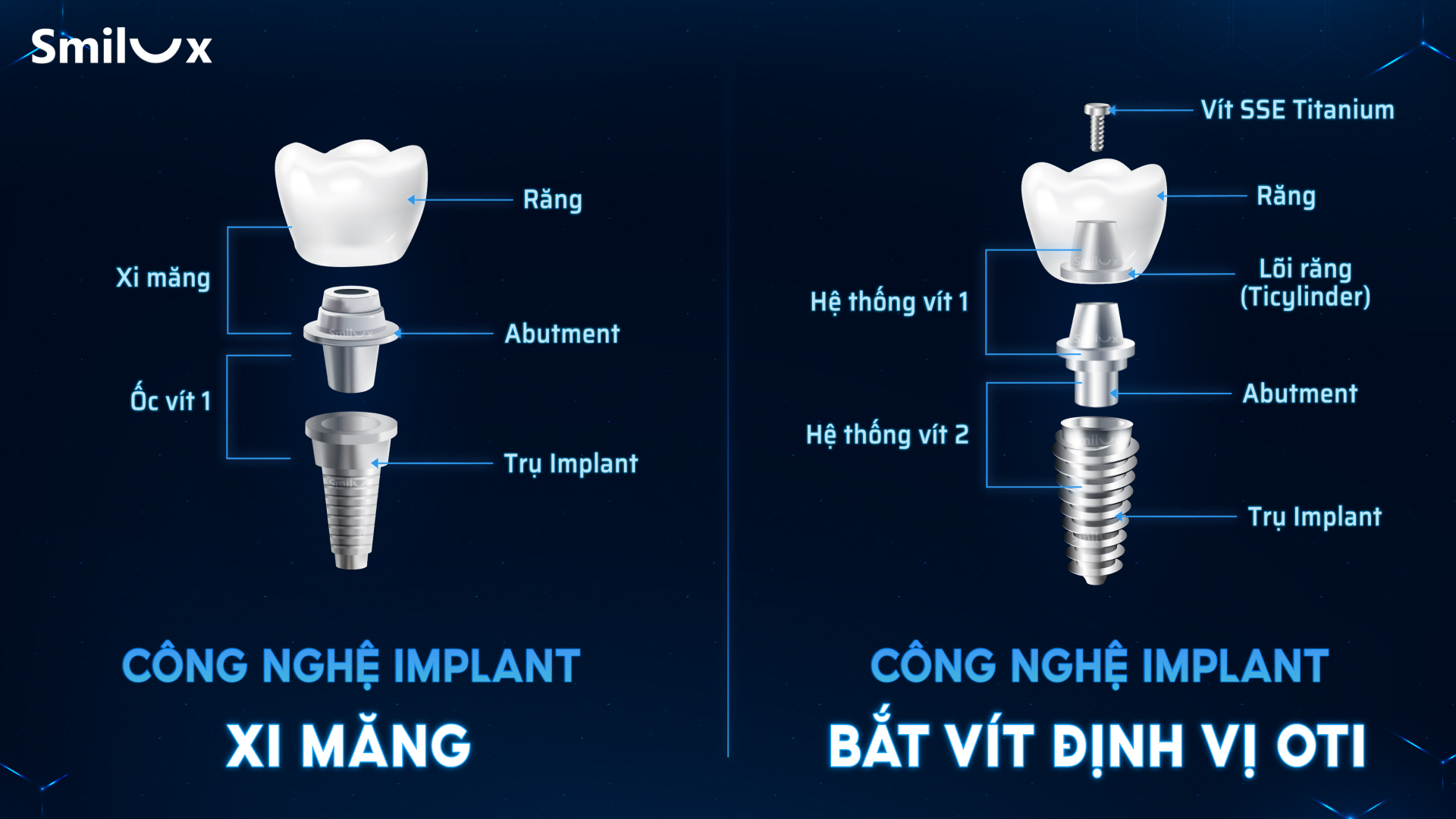 Nha khoa Smilux đột phá công nghệ trồng răng implant bắt vít định vị, không rạch lợi - 4