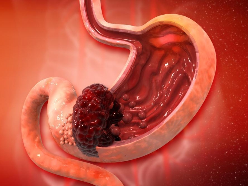 Xu hướng gia tăng ung thư dạ dày: Ẩn họa từ thói quen ăn uống thiếu lành mạnh - 1