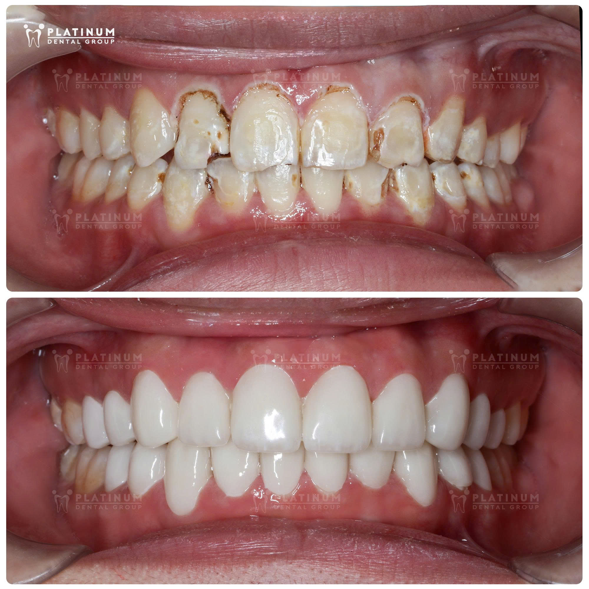 Răng sứ có mấy loại, nên chọn loại nào? - 1