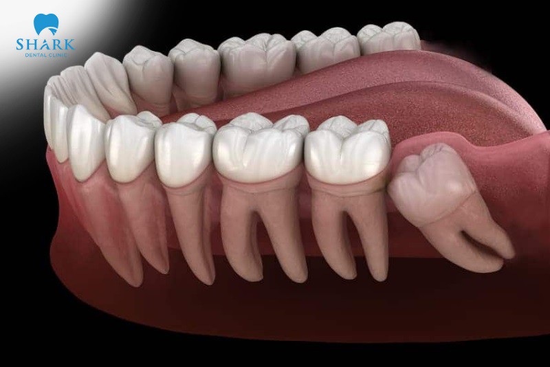 Nha khoa Shark - địa chỉ nhổ răng khôn uy tín tại Việt Nam - 1