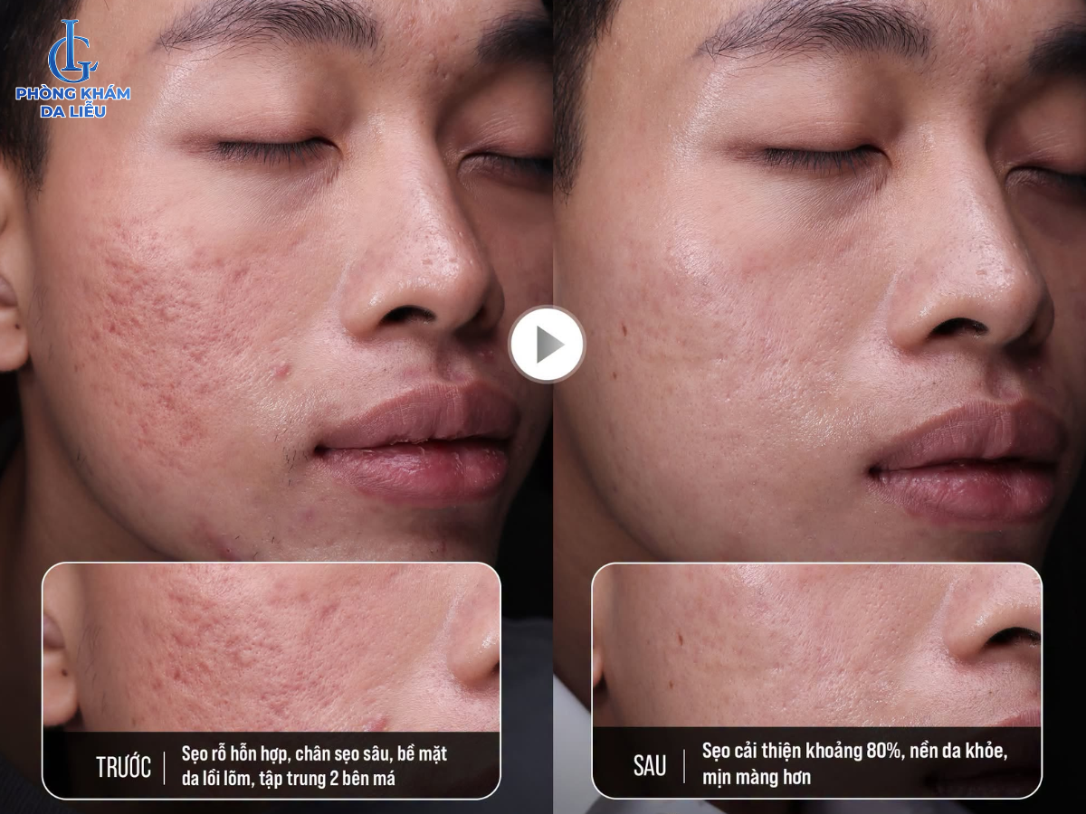 Vì sao điều trị sẹo rỗ ngày càng hướng đến phác đồ đa phương pháp? - 3